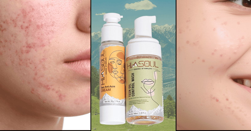Beyond Breakouts: The Best Anti-Acne Cream for Teenagers That Restores Confidence - Himsoul Enterprises