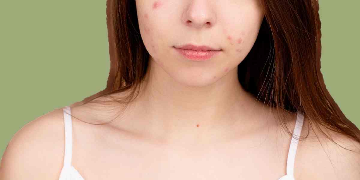 Anti Acne - Himsoul Enterprises