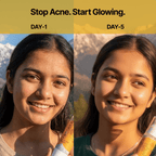 Real skin transformation showing before and after results of using Himsoul anti-acne treatment from Day 1 to Day 5.