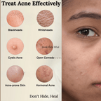 Himsoul Teen Anti - Acne Cream - Himsoul Enterprises